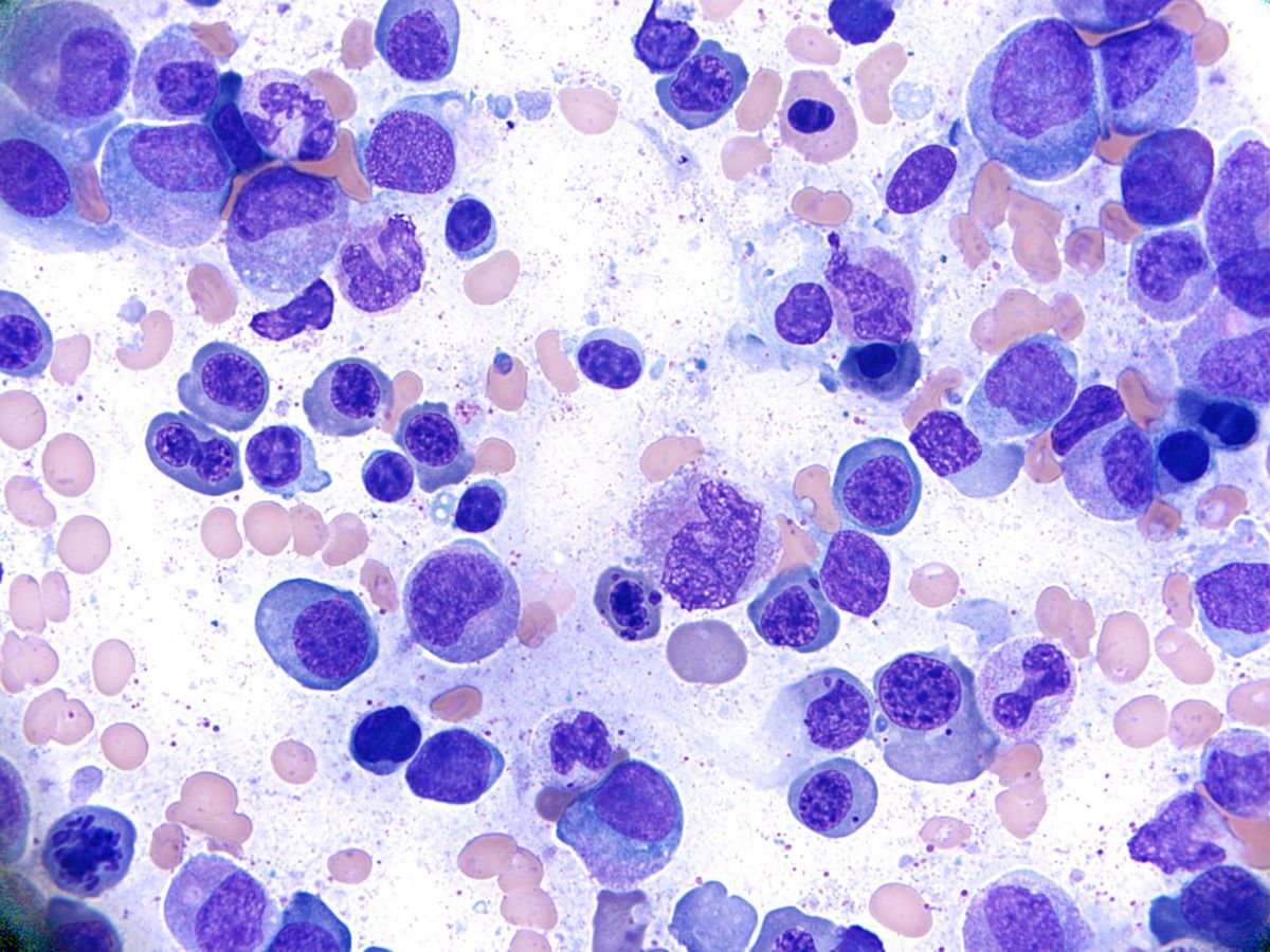 Bone marrow - Dyserythropoiesis and marked megaloblastosis.